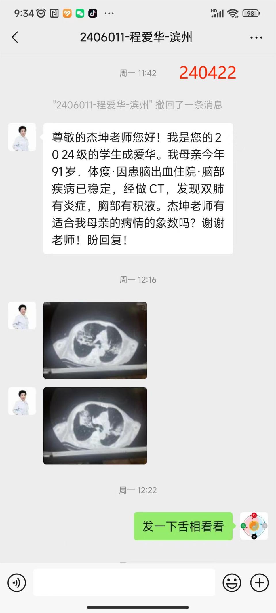 240427老人肺炎1